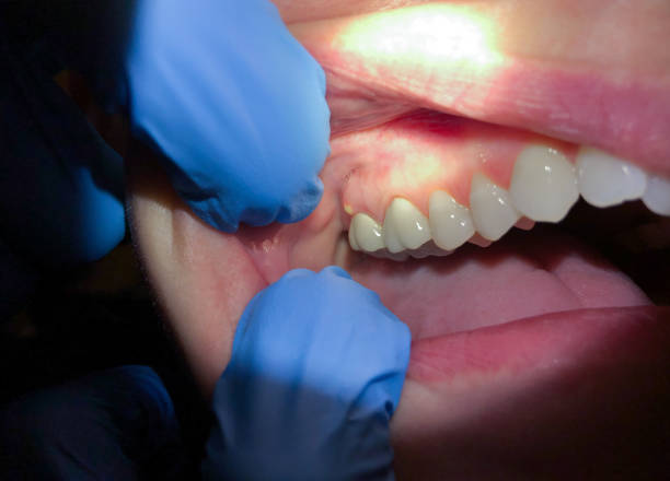 Best Emergency Root Canal Treatment in Richwood, WV